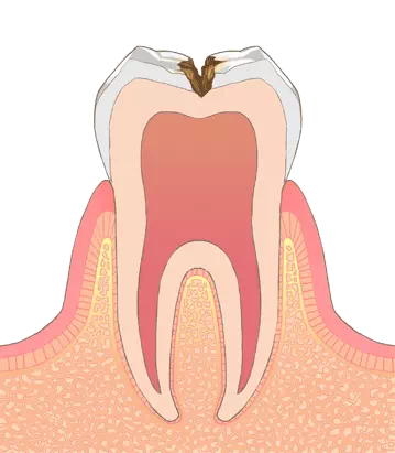 根管治療の説明をしている画像