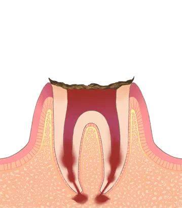 根管治療の説明をしている画像