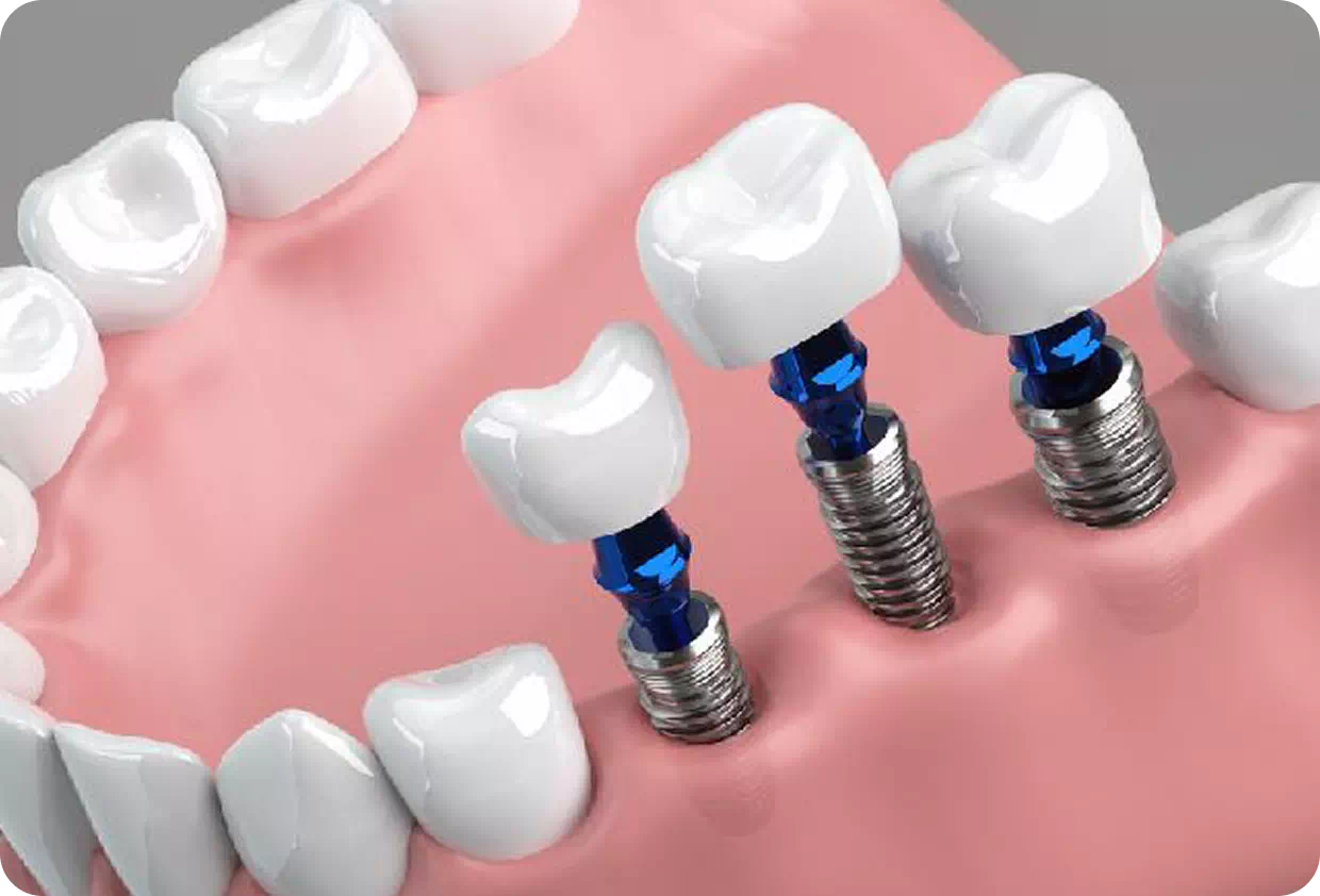 インプラントの画像